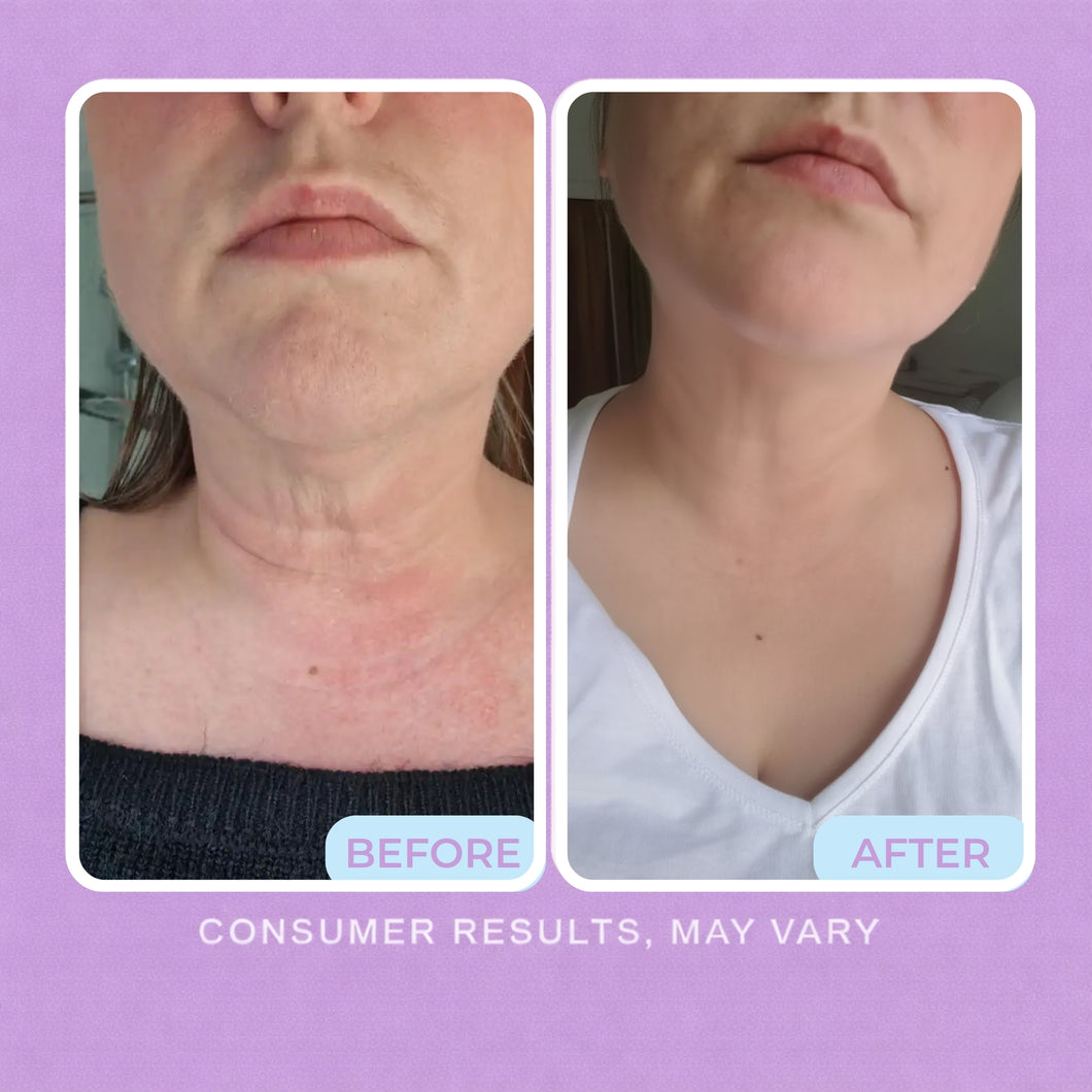 Before and after photos of a woman's neck and chest, with less redness and softer-looking lines after