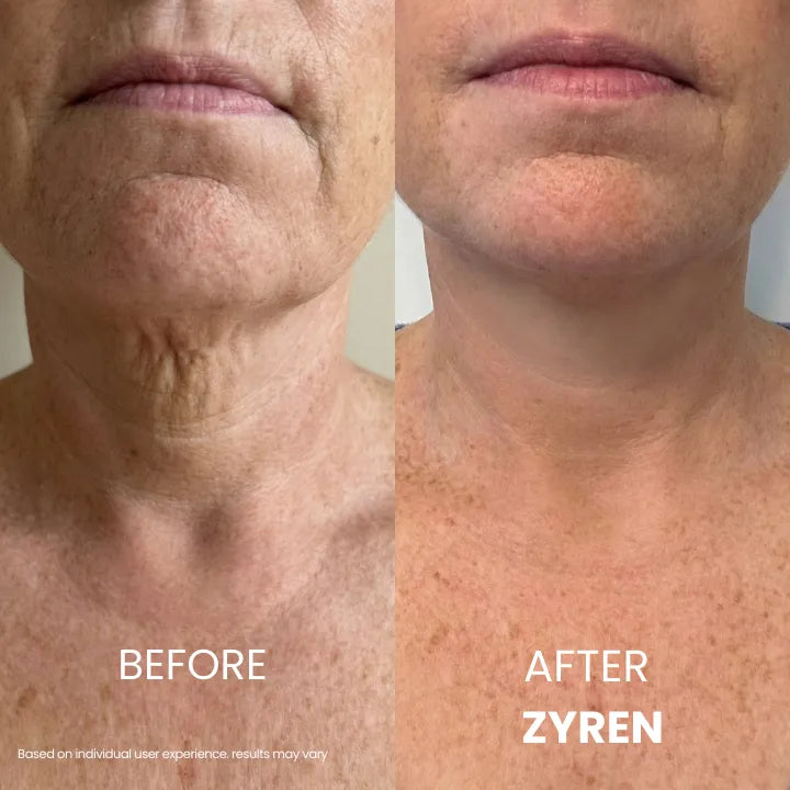 Before and after Zyren Tighten & Lift Neck Cream: close-up of a woman's neck with less visible crepey folds after