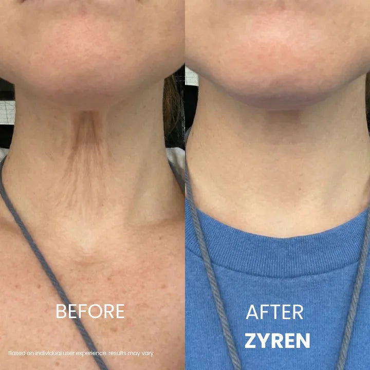Before and after Zyren Tighten & Lift Neck Cream: close-up of a woman's neck, smoother-looking skin in the after photo