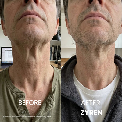 Zyren® Tighten & Lift Neck Cream [m]