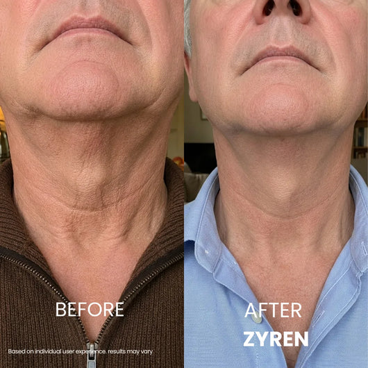 Zyren® Tighten & Lift Neck Cream [m]