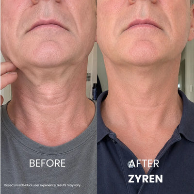 Zyren® Tighten & Lift Neck Cream [m]