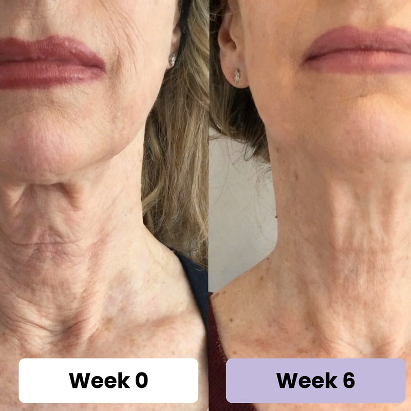 4. It's The Post-Weight Loss Neck Solution Women Have Been Waiting For