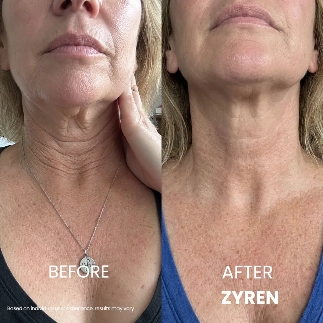 Before and after Zyren Tighten & Lift Neck Cream: woman's neck lines look softer and smoother in the after photo