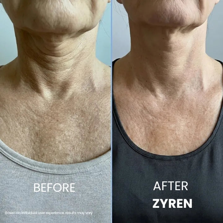 Before and after Zyren Tighten & Lift Neck Cream: woman's neck and chest, with softer-looking lines in the after photo