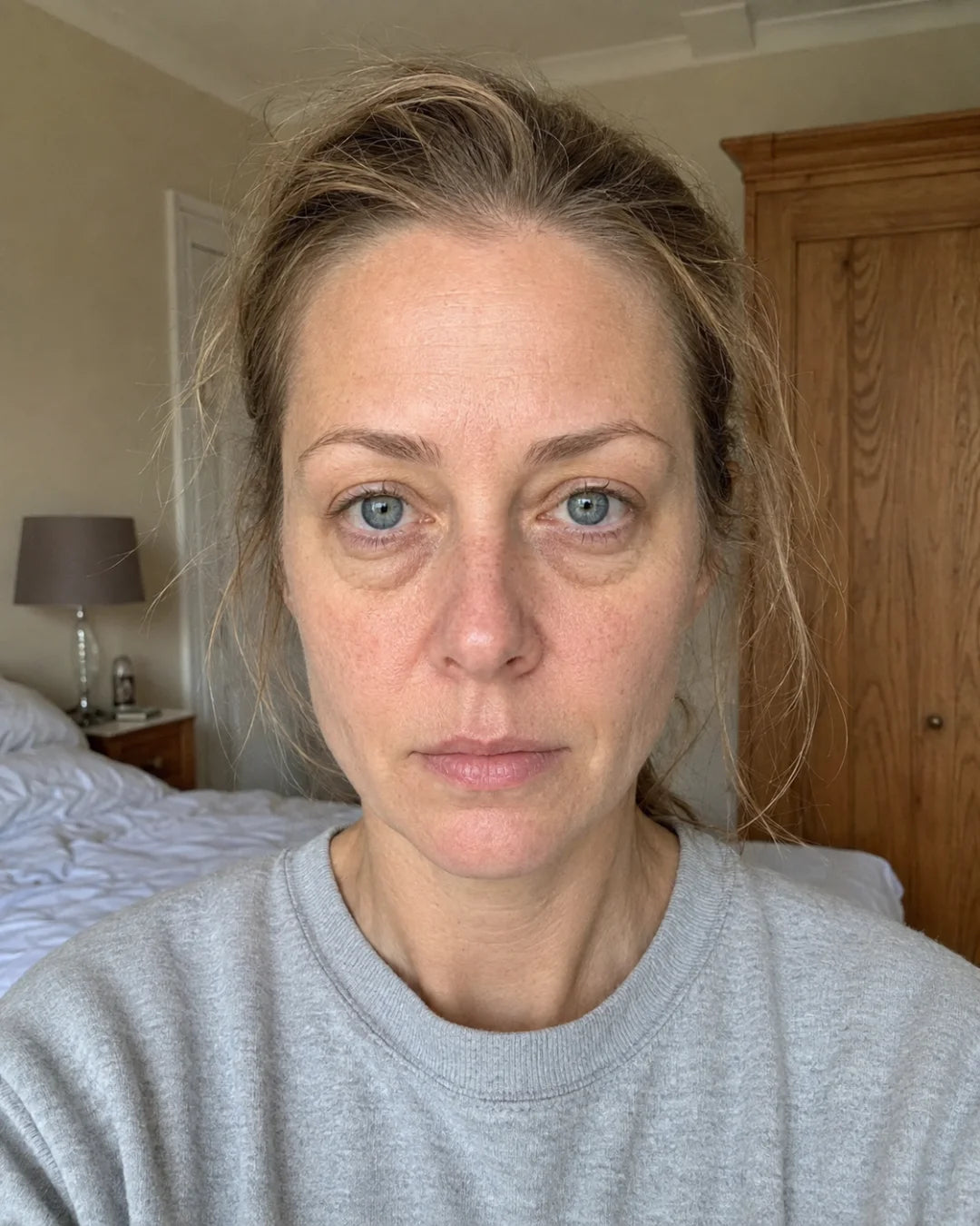 Under-eye bags before using Zyren eye cream, participant 1