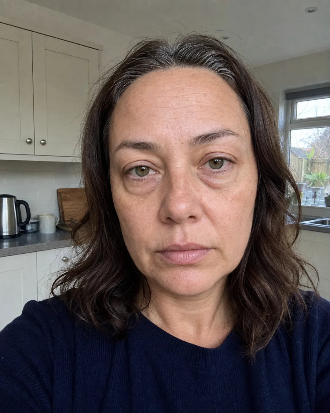 Under-eye bags before using Zyren eye cream, participant 2