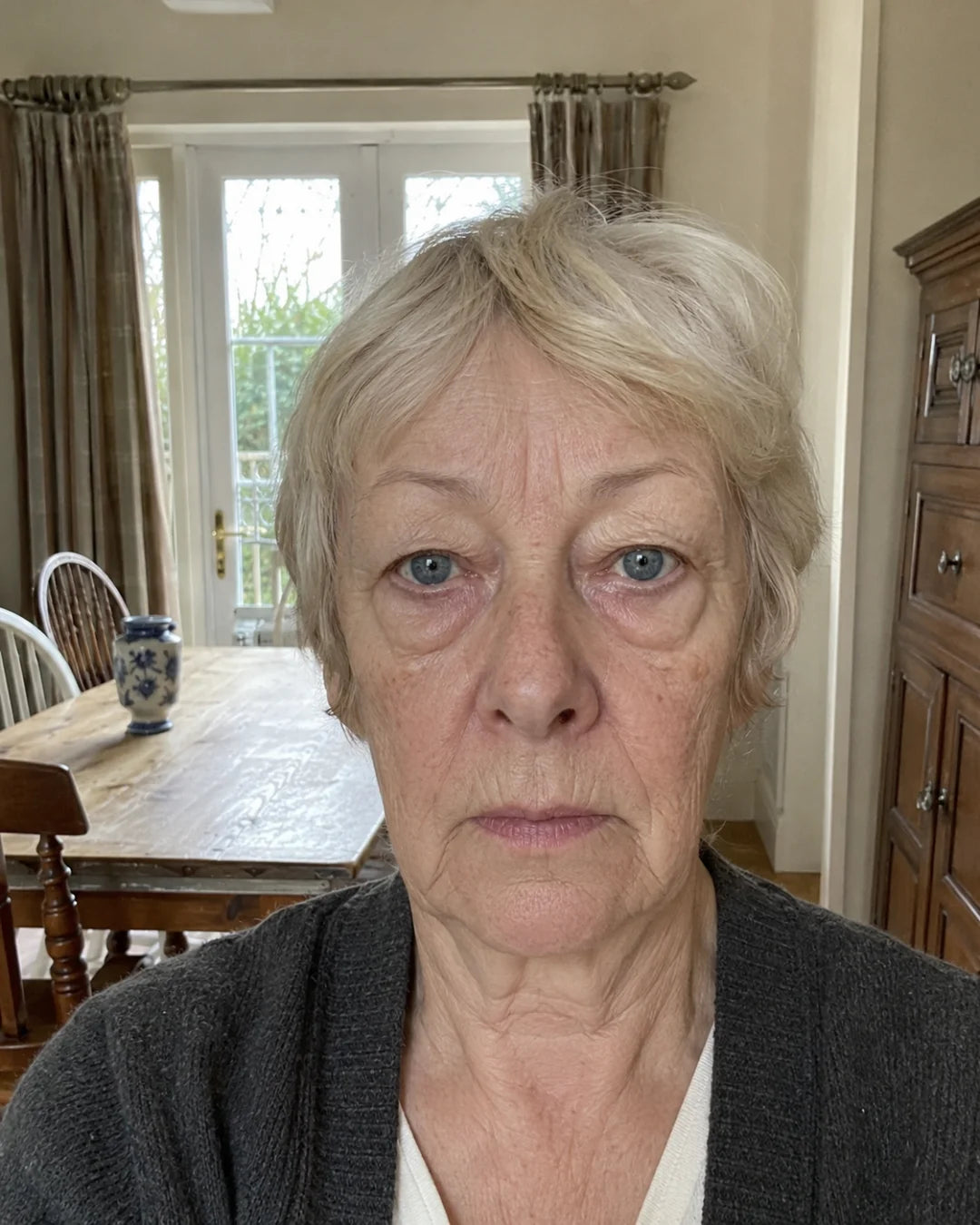 Under-eye bags before using Zyren eye cream, participant 3