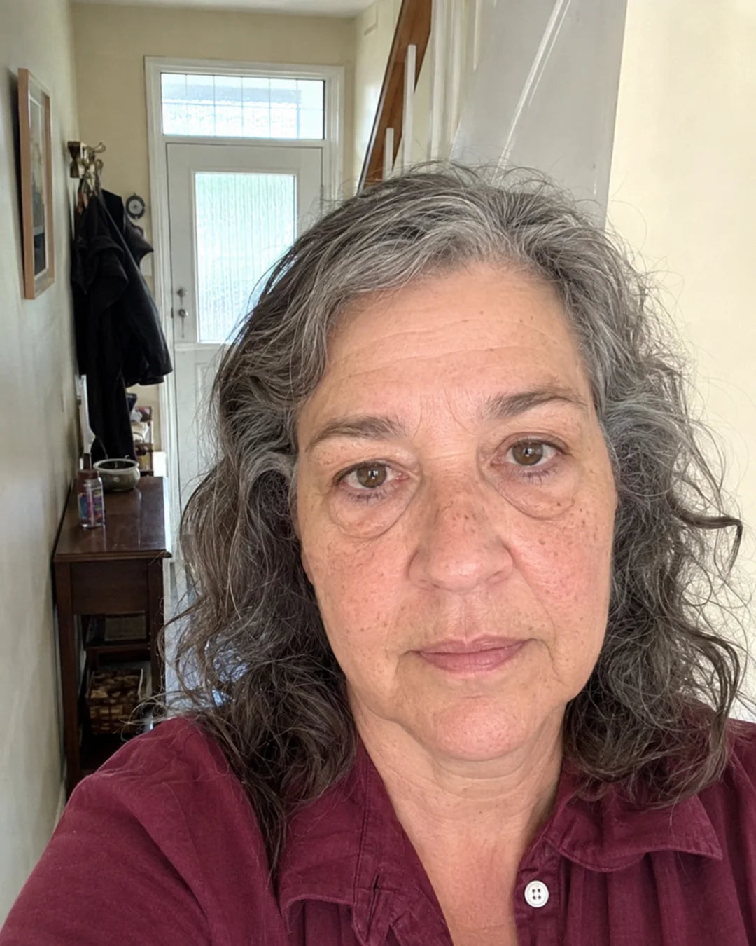 Under-eye bags before using Zyren eye cream, participant 6