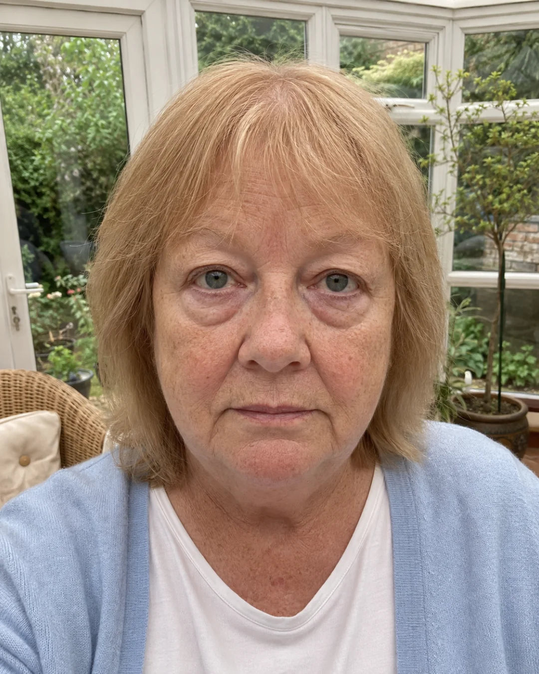 Under-eye bags before using Zyren eye cream, participant 7