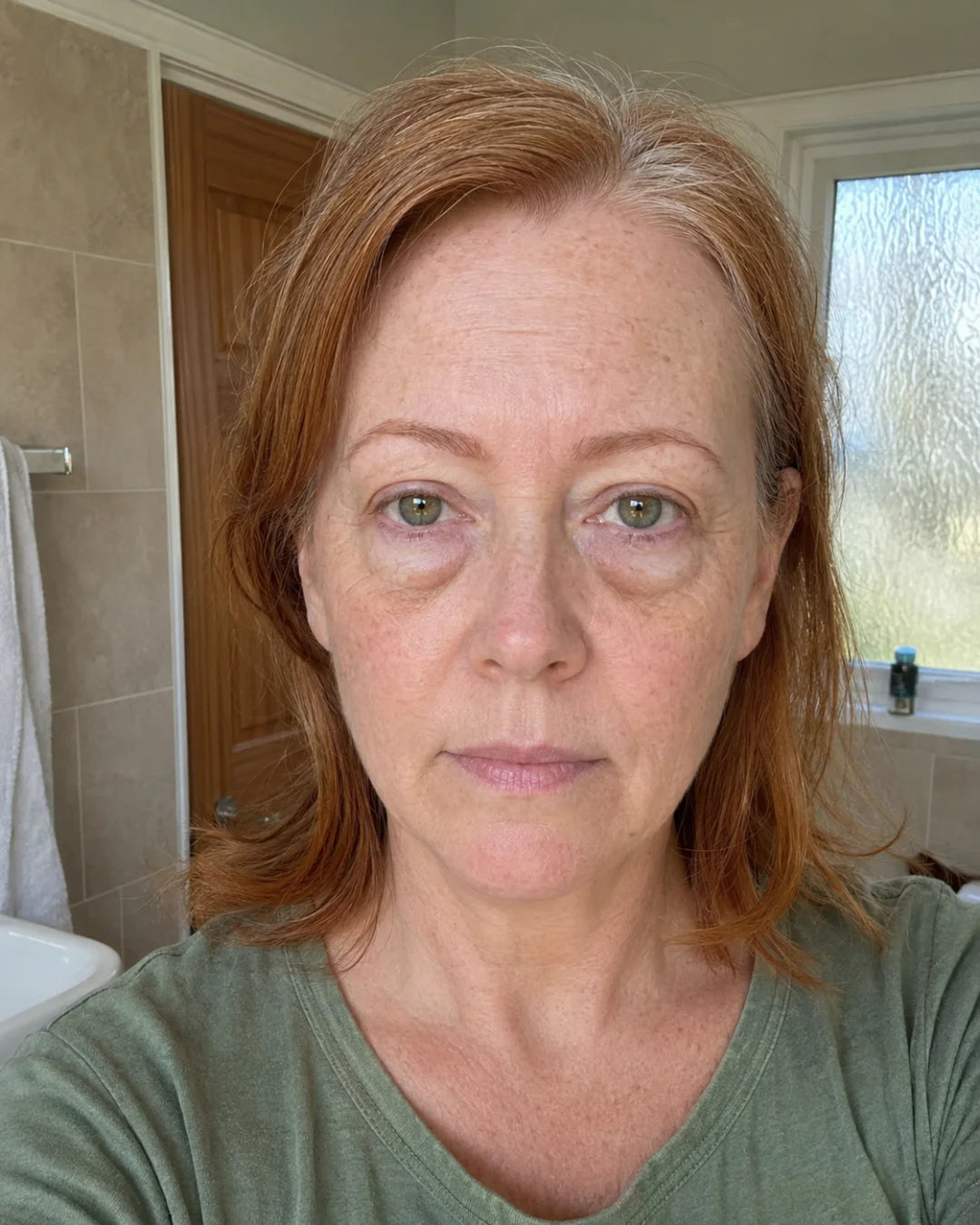 Under-eye bags before using Zyren eye cream, participant 8