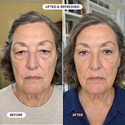 Hooded eyes before and after